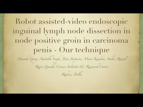 Robot assisted video endoscopic inguinal lymph node dissection in node positive groin of carcinoma penis patients