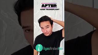 Download lagu Amazing result of Mr. Dian Ayu Ashari into full hair again in Ilyas Arslan #hairtransplant #skincare mp3 Download lagu Amazing result of Mr. Dian Ayu Ashari into full hair again in Ilyas Arslan #hairtransplant #skincare mp3
