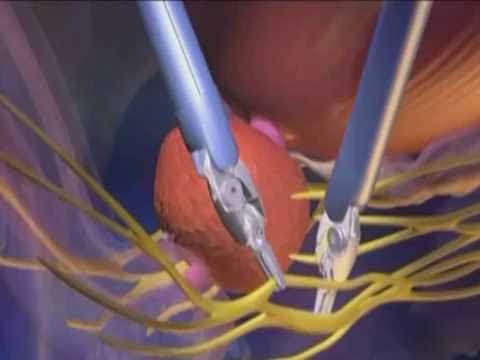 Prostata mit diffusen Verkalkungen Infusionen der Prostata