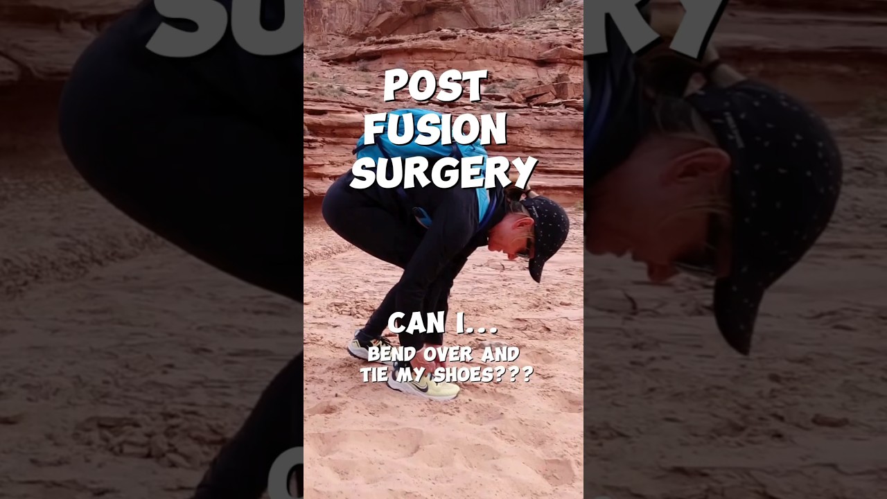 Flexibility After Fusion... What to Expect