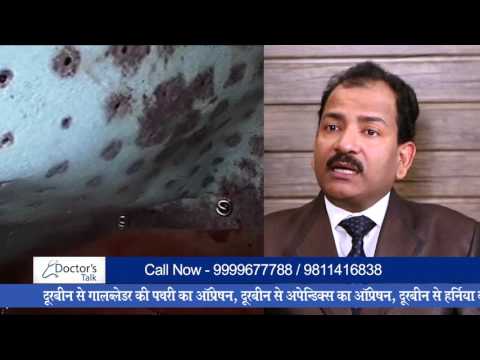 Interviewing Dr. R.K.Mishra (World Laproscopy Hospital)- Hindi about Hernia