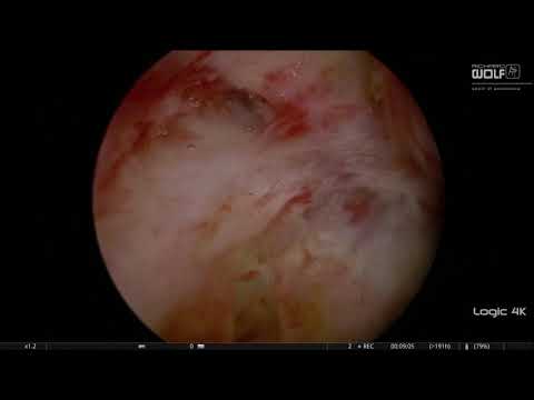 Pulsed Thulium Laser Anatomical Endoscopic Enucleation of...