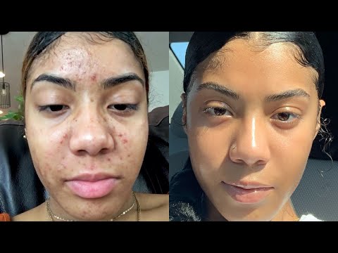 download lagu mp3 mp4 Braggs Apple Cider Vinegar Safeway, download lagu Braggs Apple Cider Vinegar Safeway gratis, unduh video klip Braggs Apple Cider Vinegar Safeway