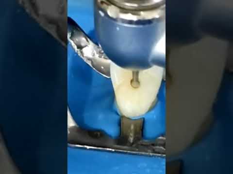 access opening of upper central incisor