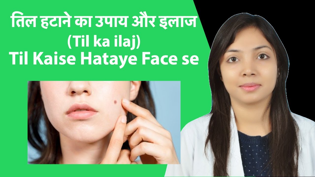 तिल हटाने का उपाय और इलाज (Til ka ilaj) | Til Kaise Hataye Face se | Chehre ke Til Hatane ka Tarika