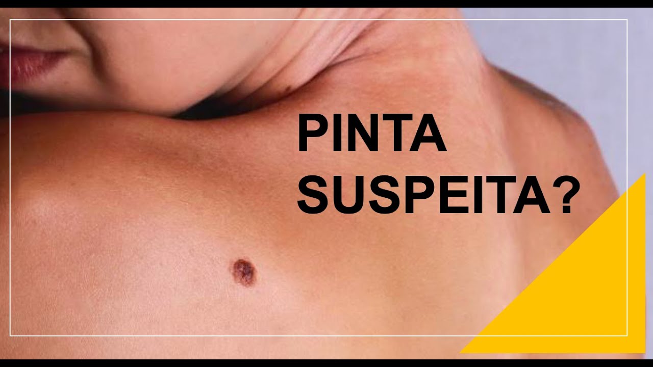 COMO SABER SE UMA PINTA É SUSPEITA? Por Luiz Gameiro, dermatologista