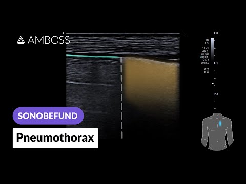 Sonobefund: Pneumothorax | AMBOSS