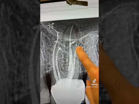 Endodontic treatment of this calcified tooth #14.