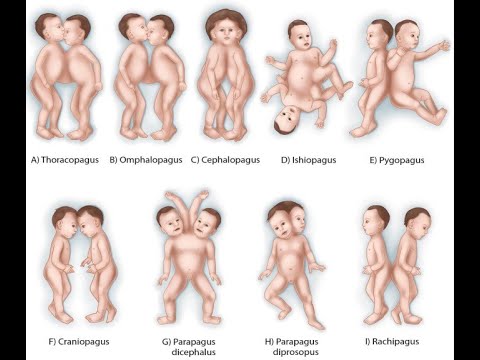 Conjoined (Conjoint) monozygotic twins; Craniopagus, Thoracopagus, Pygopagus and cephalothoracopagus