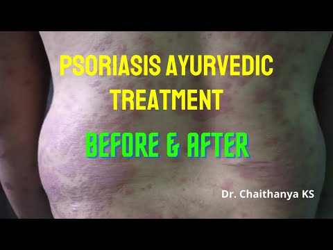 Psoriasis Treatment