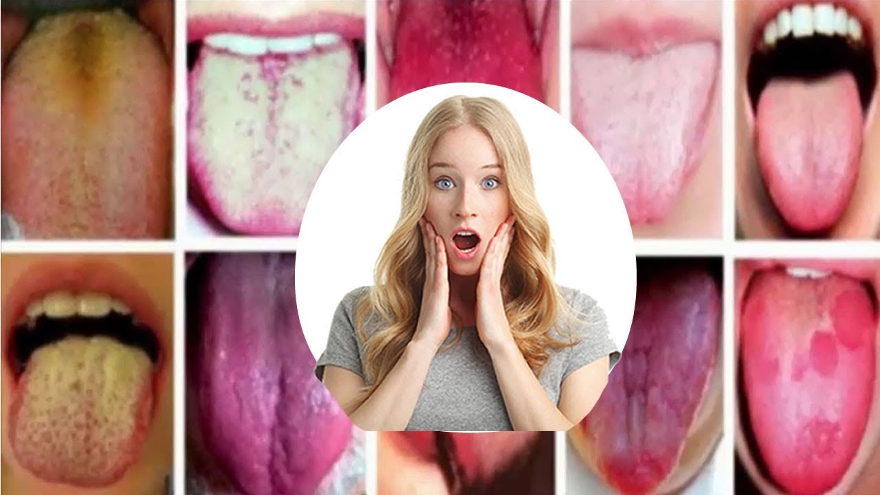 Mira cómo la lengua revela qué enfermedades padeces