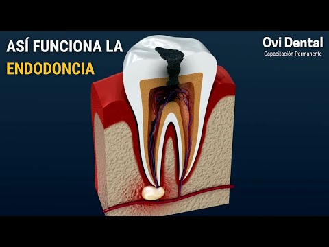 ASÍ FUNCIONA LA ENDODONCIA