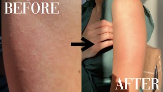 HOW I CLEARED MY KP (KERATOSIS PILARIS) & ACNE  (2 YEAR UPDATE)| Before & After