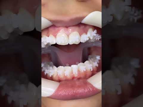 BRACES ON‼️🫶🏼#reels #shullmanorthodontics