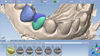 Planmeca Workflow for Multiple unit anterior veneers