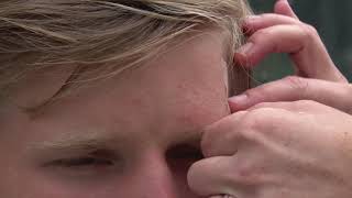 Wat te doen bij een open wond?