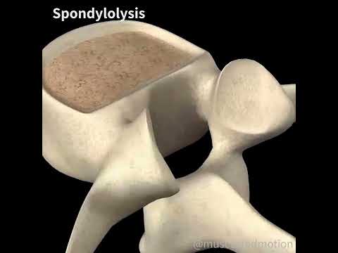 SPONDYLOLYSIS 🧽