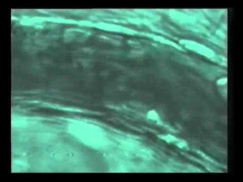 Divertikel Prostata Verkalkungen in der Prostata, dass diese Behandlung