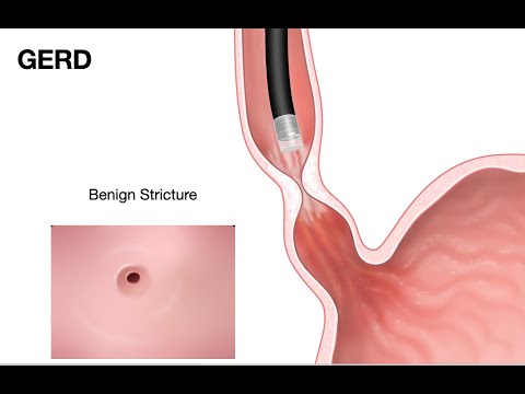 ECE-2e-Pathology of Esophagus-Esophageal stricture