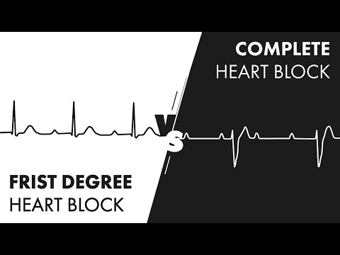 First vs Third Degree Heart Block