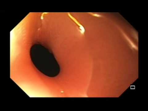 Perforación retroperitoneal del colon descendente