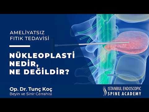 Kapalı Fıtık Tedavisi Nükleoplasti