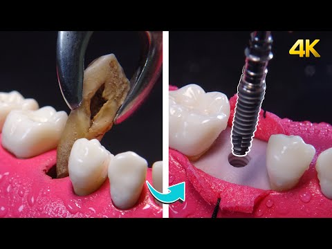 Step-by-step dental implants in 4K