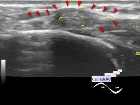 Pediatric soft tissues ultrasound - Subcutaneous lesion above the sternum