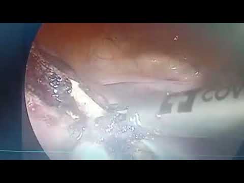 Endometriosis Cystectomy