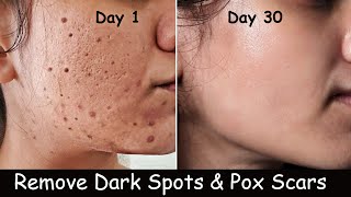 Remove DARK SPOTS & ChickenPox Scars Marks on Face at Home - Hyperpigmentation & Large Open Pores
