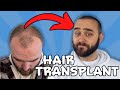 FUE HAIR TRANSPLANT - Is It Worth It?