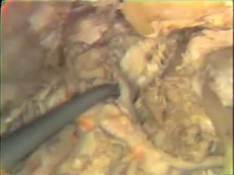 TMJ, Pterygoid Muscles, Maxillary Vessels