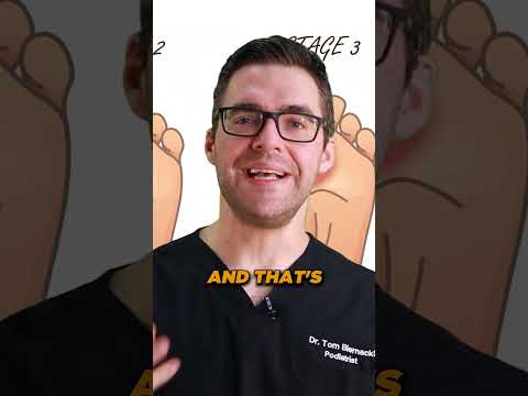 Numbness or Tingling in the Feet or Toes Morton s Neuroma Treatment