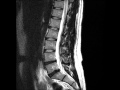 Lumber MRI Degenerative Disc Disease With ...