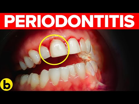 Periodontitis: Stages, Symptoms, Causes & Treatment
