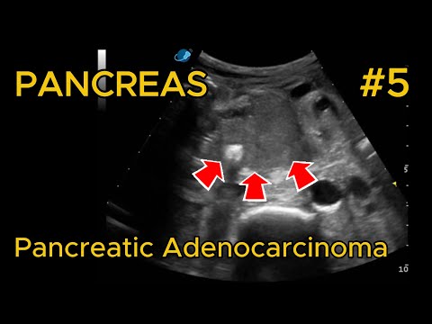 Pancreatic adenocarcinoma (head/uncinate) video preview