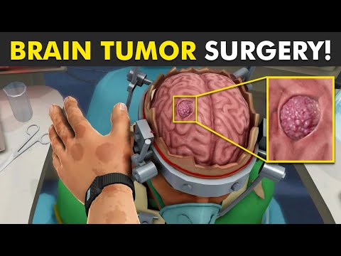 How Brain Tumor Is Removed From Brain Through Surgery?