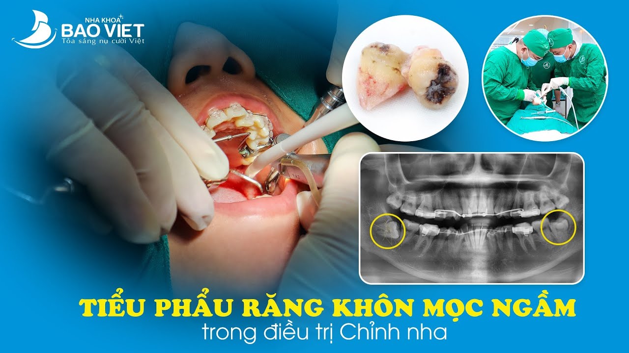 TIỂU PHẪU RĂNG KHÔN MỌC NGẦM TRONG ĐIỀU TRỊ CHỈNH NHA
