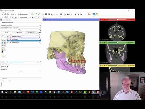 Segmentator , A very nice 3D Slicer module to segment cone beams. It is free to use and works well