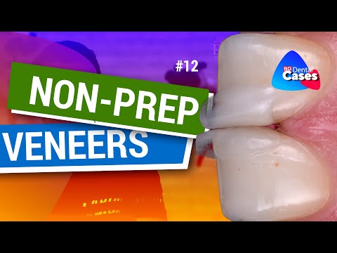 Non-Prep Veneers - Clinical Case