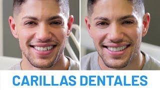 Carillas Dentales de Composite [Antes y Después de David Lafuente] - Clínicas Diego de León