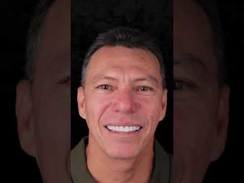 Diseño de sonrisa, carillas dentales en Santa Marta - Odontólogo Albeiro Garcia Varela