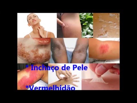 Statistica dincidenza di psoriasi Linumidimento di crema a eczema di mani