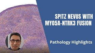 Spitz nevus with MYO5A-NTRK3 fusion