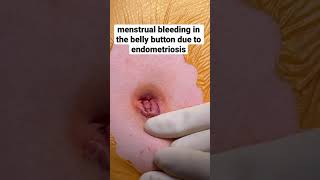 Menstrual blood in belly button due to #endometriosis.