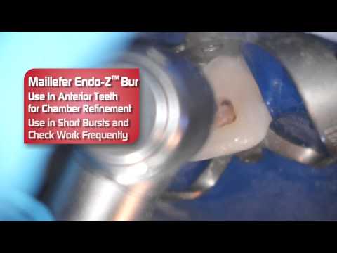 Dentsply EndoZ Bur - Review by Dr. Scott Norton