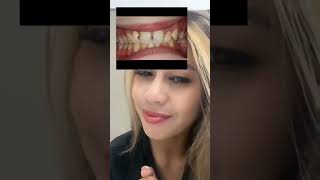 Download lagu Solusi untuk gigi depan berlubang👌 #gigiberlubang  #berlubangdidepan mp3