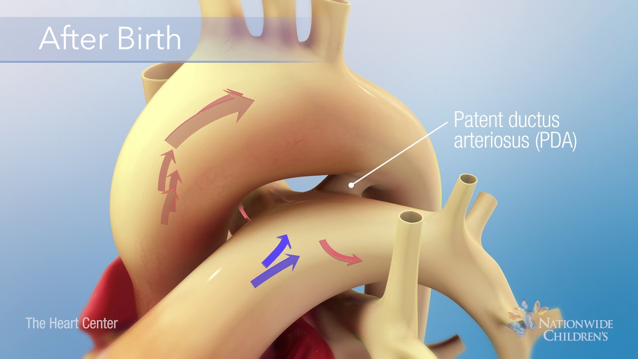 Patent Ductus Arteriosus (PDA) Occlusion Procedure