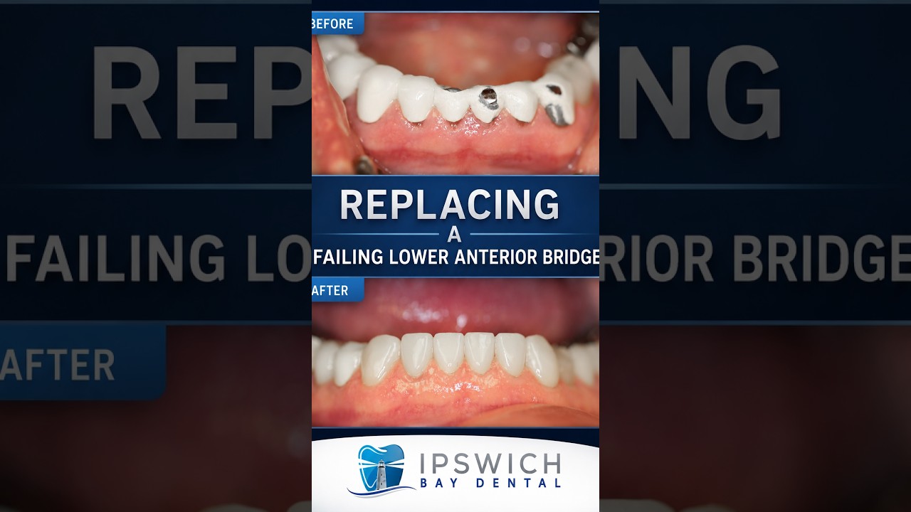Fixing Bridges clinical case video thumbnail