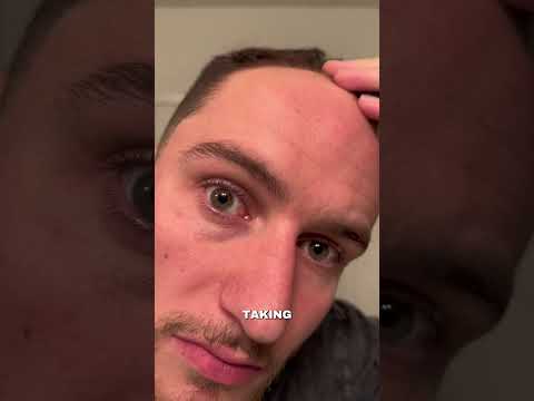 am I cooked #hair #hairtransformation #hairgrowth #bald #update